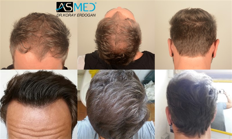 5007 Grafts Fue Asmed Turkey Hair Transplant In Turkey