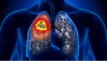 Blog 7 Facts You Need To Know About Lung Cancer Nfcr