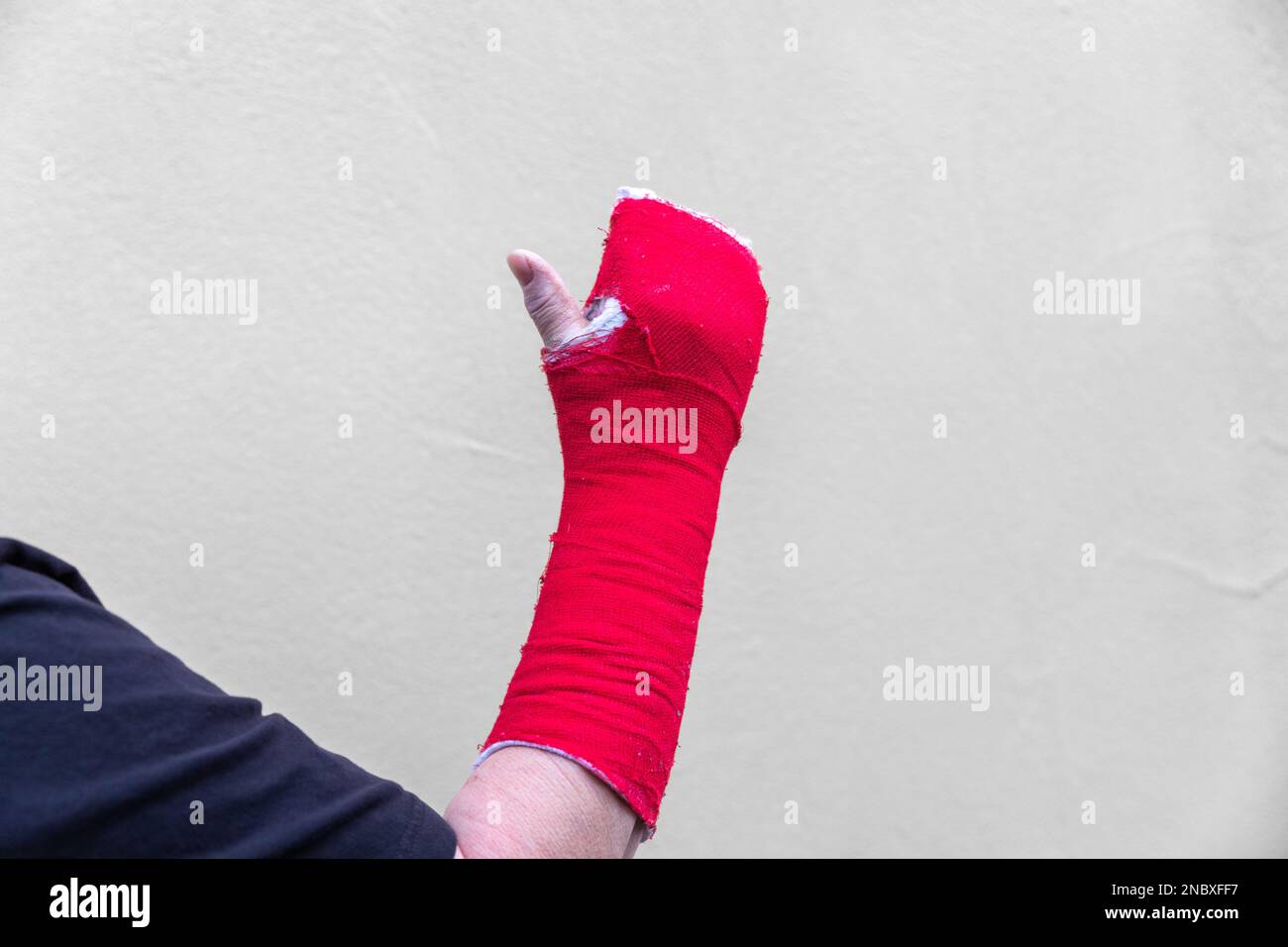 Broken Arm Bone In Cast Red Stock Photo Alamy