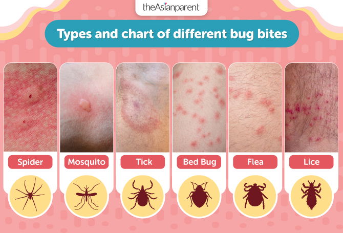 Bug Bites And Stings: Pictures, Identification, Treatment, 47% Off