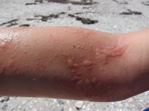 Graphic Image Warning How To Avoid And Treat The Worst Rashes And Bites