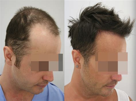 Hair Transplant Turkey From 1199 Free Consultation In Uk Gethair