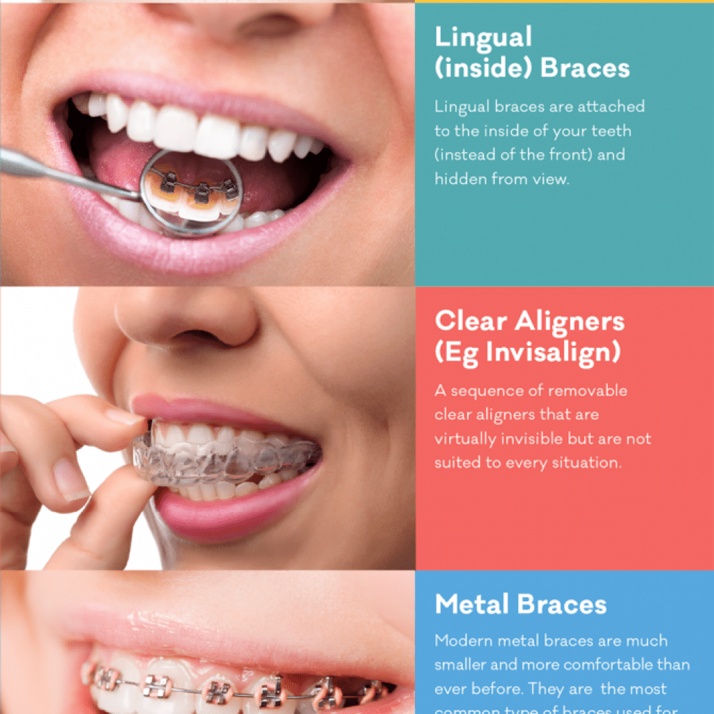 Invisible Braces Guide How Fast Can Teeth Straighten