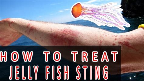 Jellyfish Stings How To Treat Jellyfish Sting Youtube