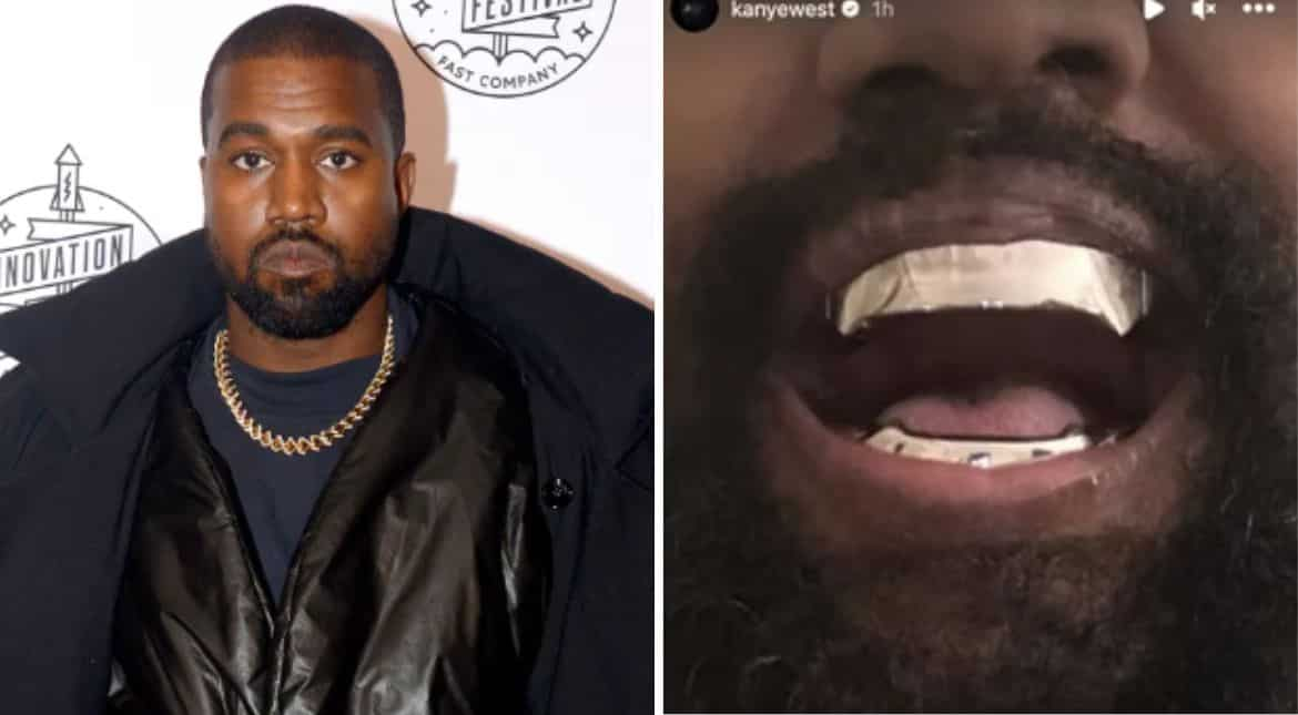 Kanye West Shocks Fans As He Has Teeth Replaced With Bizarre 670 000