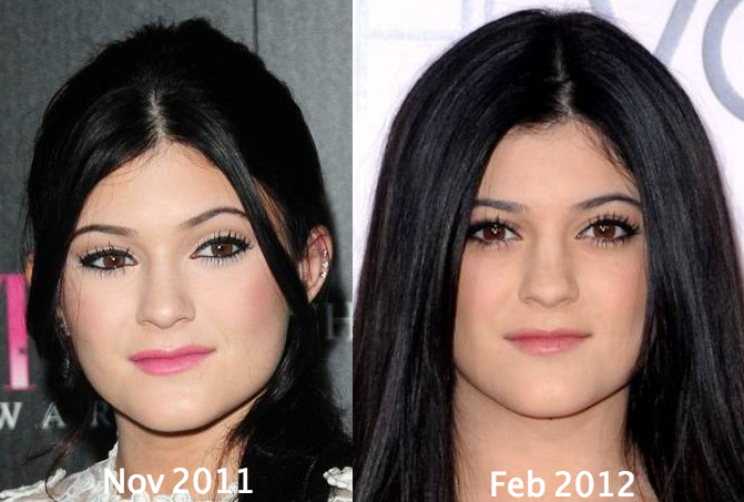 Kylie Jenner Before And After All Of Her Plastic Surgery