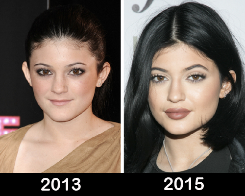 Kylie Jenner Before And After Plastic Surgery Kylie Jenner Plastic