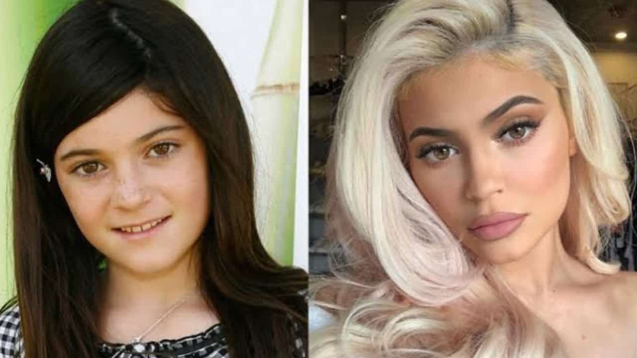 Kylie Jenner Before And After The Beauty Mogul Confessed Undergoing