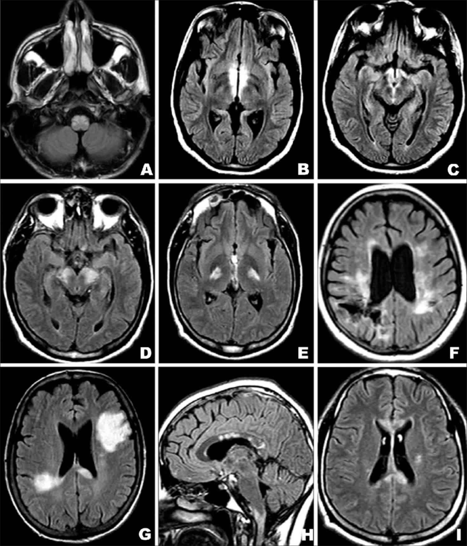 Lesions On The Brain Symptoms Causes Diagnosis And Treatment Mri