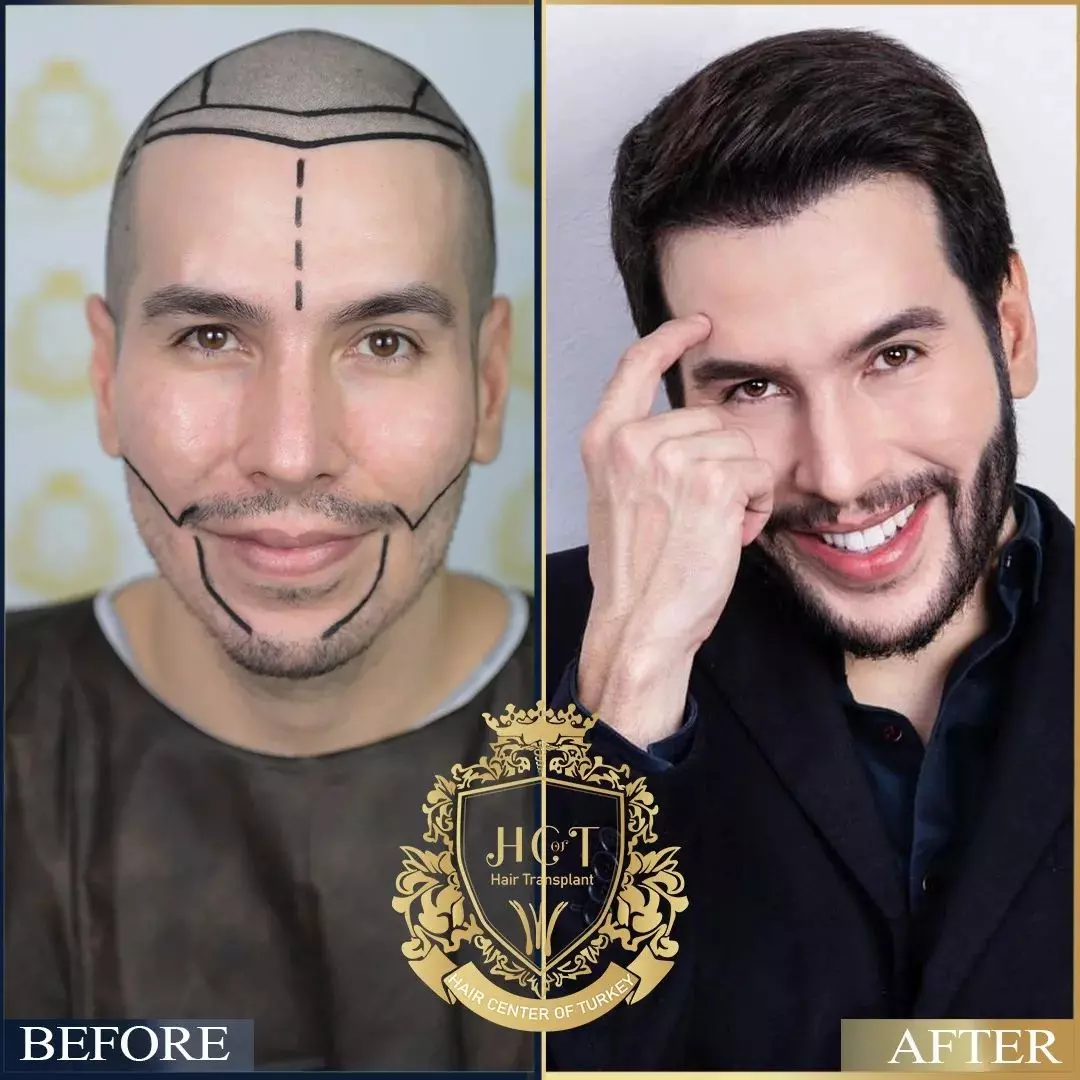 Turkey Hair Transplant Results Hair Transplant In Turkey