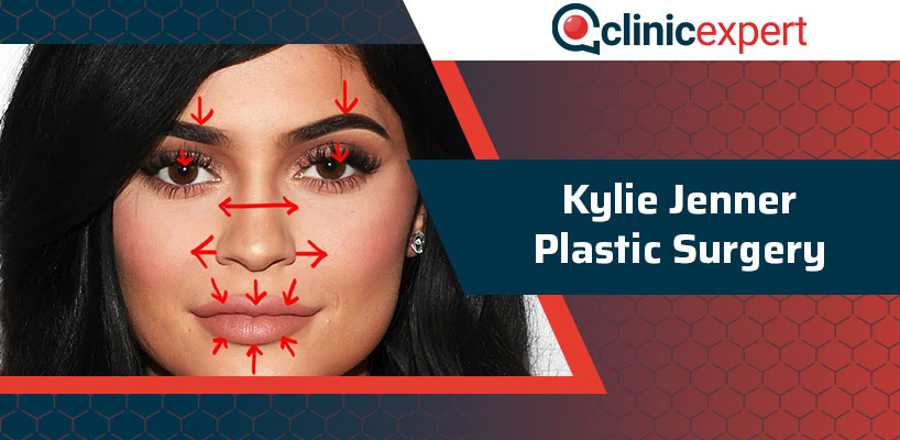 Ultimate Guide: 7 Secrets To Perfect Kylie Jenner Surgery